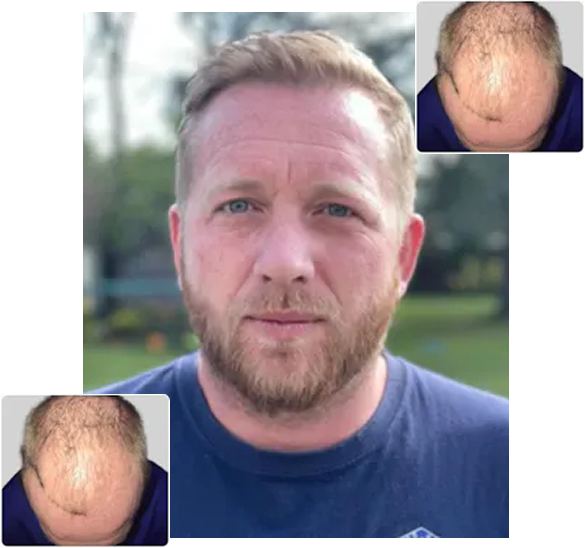 Group 4868789 Hair Transplant Leading Expert | Dr. Stoller