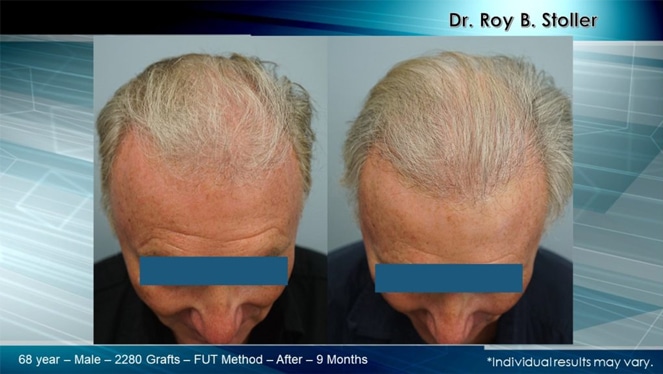 Hair Transplant Leading Expert | Dr. Stoller