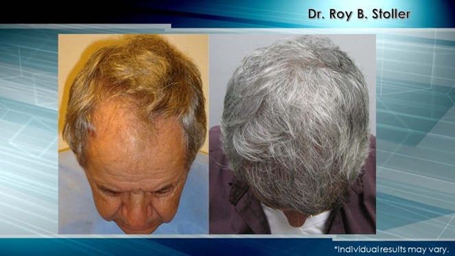 before and after Hair Transplant Leading Expert | Dr. Stoller