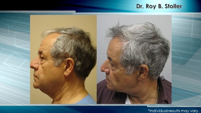 before and after