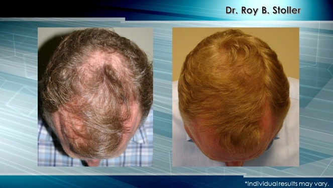 Hair Transplant Leading Expert | Dr. Stoller before and after