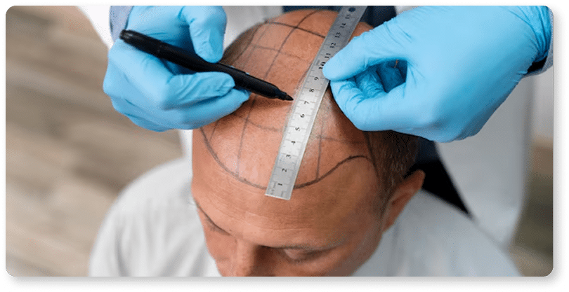 hair surgery marking